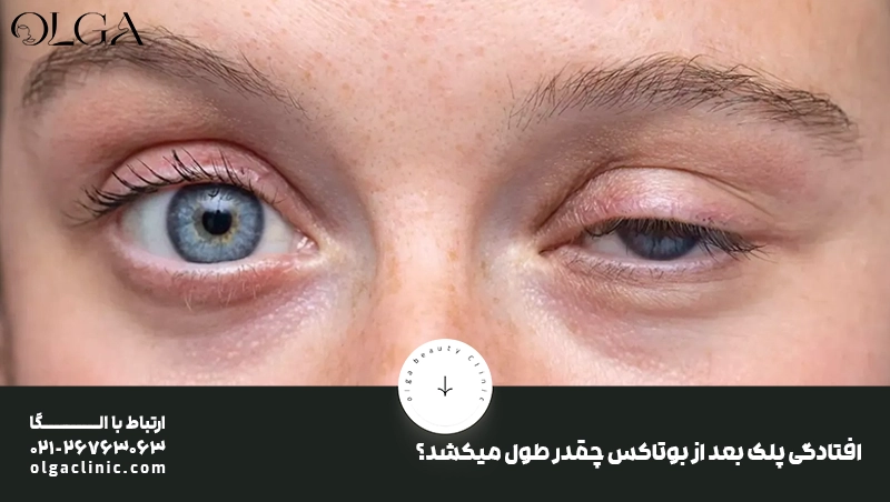 افتادگی پلک بعد از بوتاکس چقدر طول میکشد؟