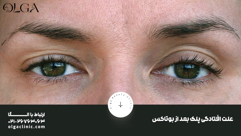 دلایل افتادگی پلک پس از بوتاکس
